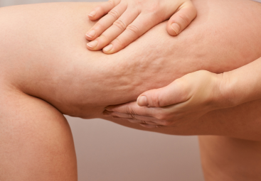 Celulitida očima medicíny, TCM a ajurvédy | LIPOELASTIC
